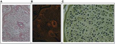 Light-Chain Amyloidosis With Peripheral Neuropathy as an Initial Presentation